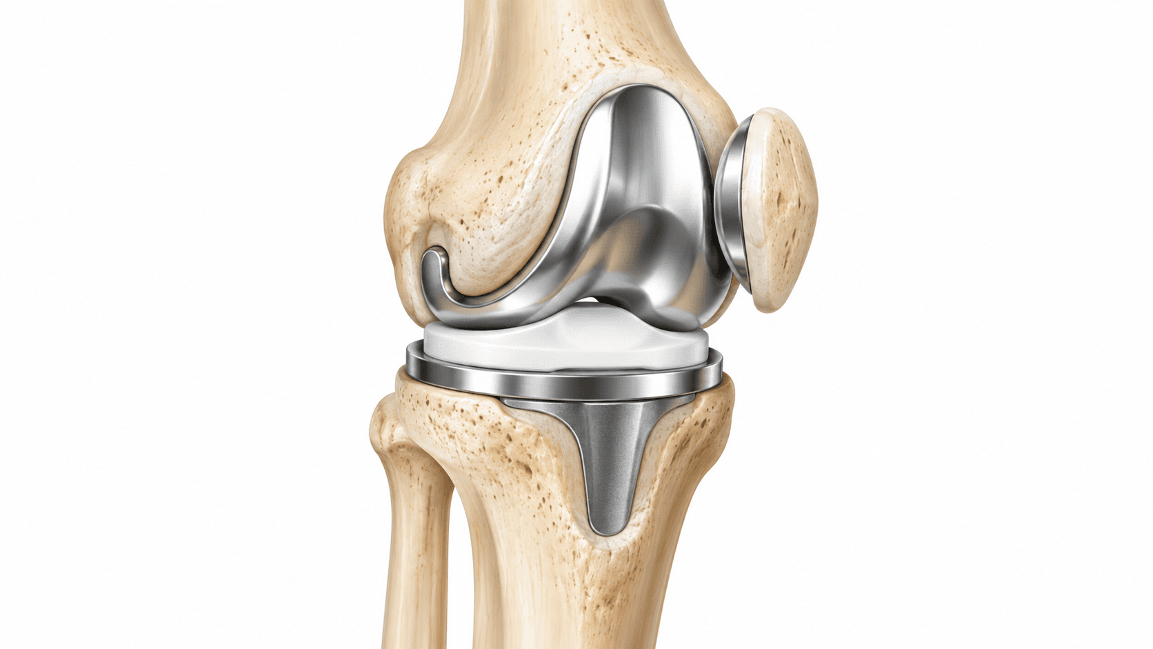 Medical illustration of total knee replacement showing metal femoral and tibial implants with a polyethylene spacer replacing the damaged knee joint surfaces.